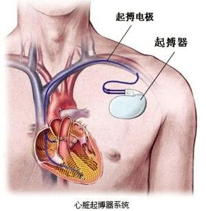 军医：识别3种假心律失常，不需要花5万块钱植入心脏起搏器