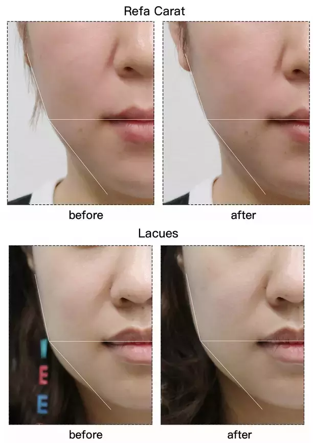 套路还是真有用？千元Refa和9.9元的滚轮瘦脸仪到底有差别吗？