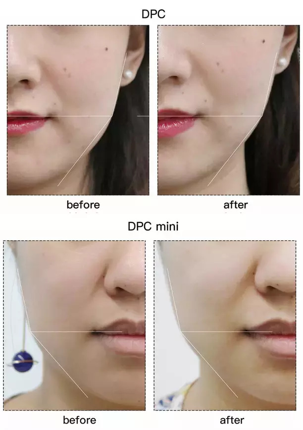 套路还是真有用？千元Refa和9.9元的滚轮瘦脸仪到底有差别吗？