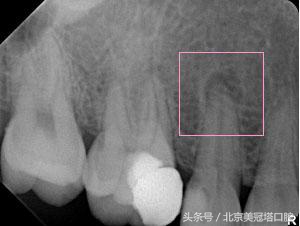 看牙要不要拍片，这是必要的检查还是浪费钱