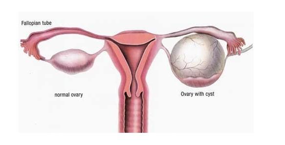 卵巢囊肿如何进行手术？如果不选择手术，还有别的治疗方法吗？