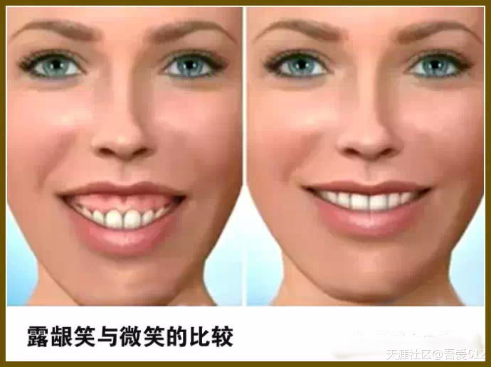 “露龈笑”严重，是戴牙套就能解决的吗？