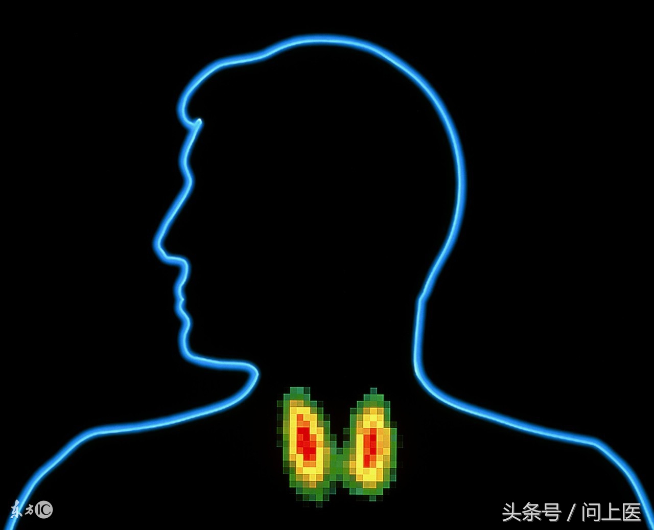 甲状腺功能减退除了定期检查甲状腺激素水平，这10项检查也很重要