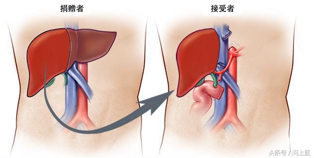 肝功能检查指标异常是什么原因？医生是如何诊断肝病的？