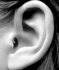 耳朵冻肿了怎么办