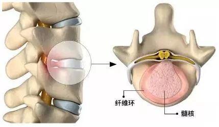 如何利用普拉提改善腰椎间盘突出(普拉提怎么改善腰椎间盘膨出)