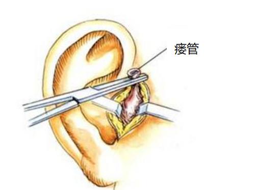 耳前鬓角旁有小洞是多福的“仓”？你还不知道耳前瘘管是什么吗？