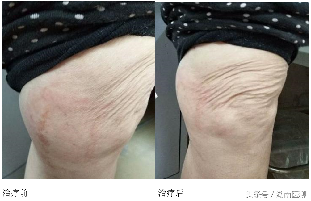 腿脚常抽筋苦不堪言？目前这种疗法对治腿抽筋超有效！