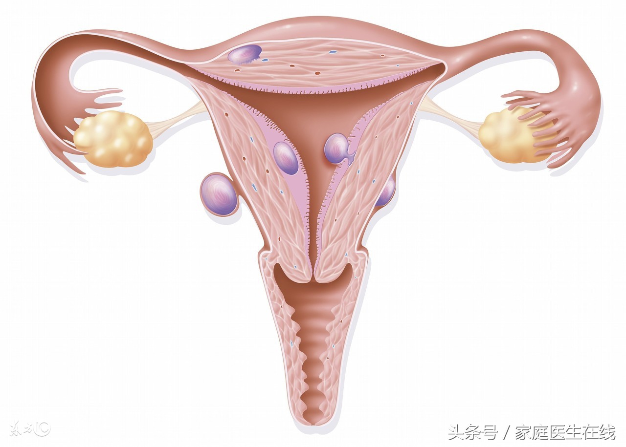 子宫肌瘤多大，需要手术治疗？治疗的三个要点要先搞清楚