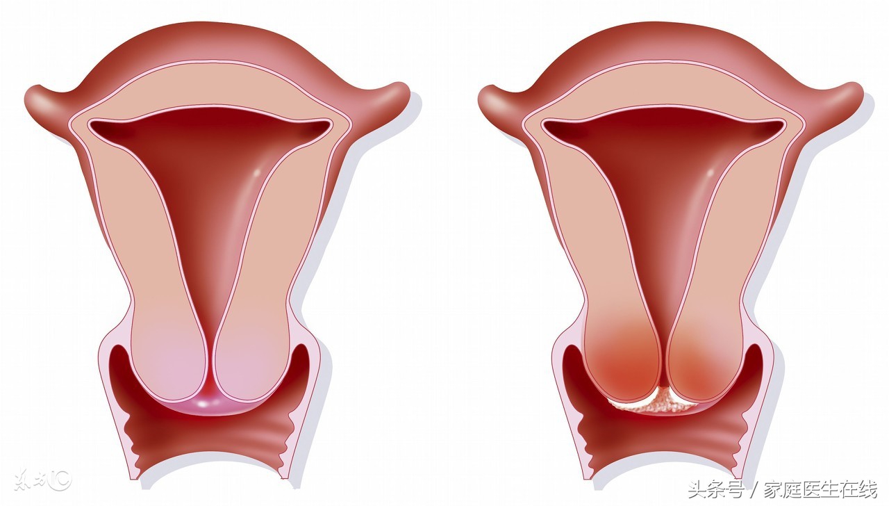 妇科医生：5种检查帮你“揪出”宫颈癌，早点做到的人真幸运！