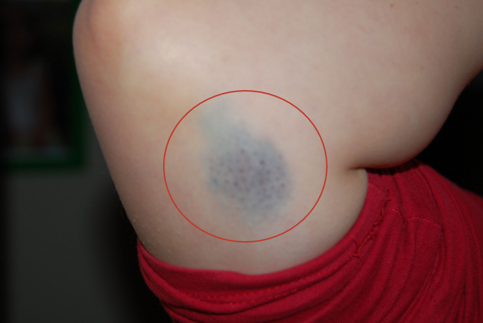 没磕没碰,皮肤出现淤青,是身体出了什么问题?