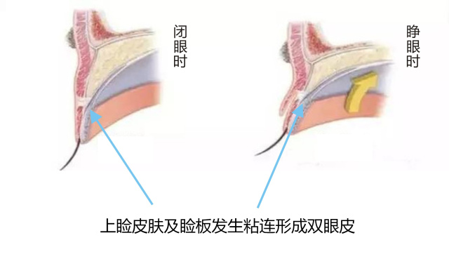 双眼皮做失败了，重睑过宽，过窄，不对称怎么办？修复效果怎样？