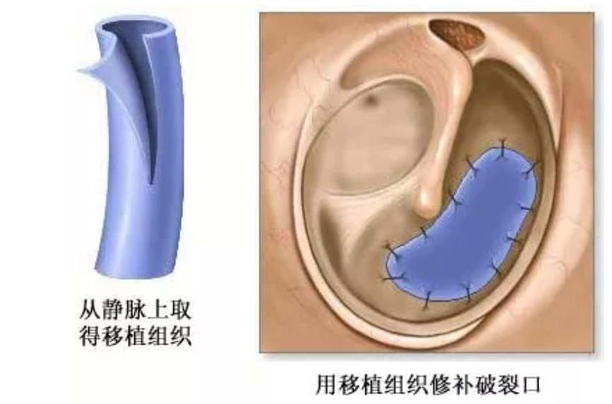 仅打一耳光，听力下降甚至会聋？耳朵鼓膜破了怎么办？