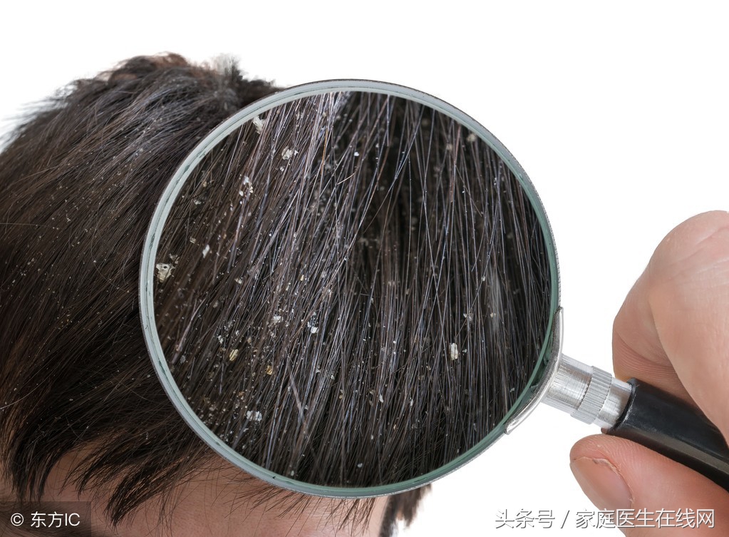 隔一天不洗头，就头痒、头屑多？医生：可能染上了这2种病