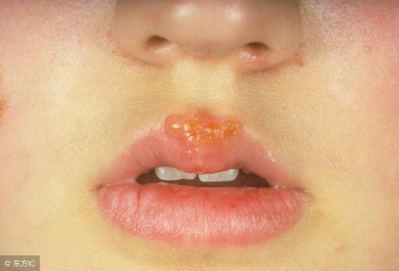 艾滋病的嘴唇疱疹图片图片