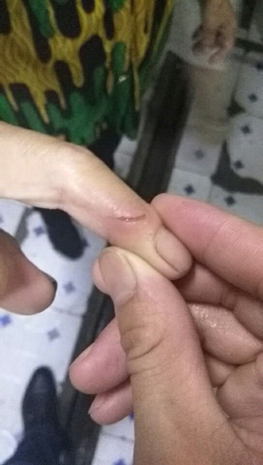 手部被老鼠咬了怎么办