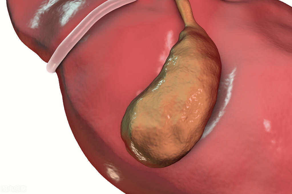 胆囊息肉样变是什么意思？胆囊息肉生长速度快，想切除有什么影响