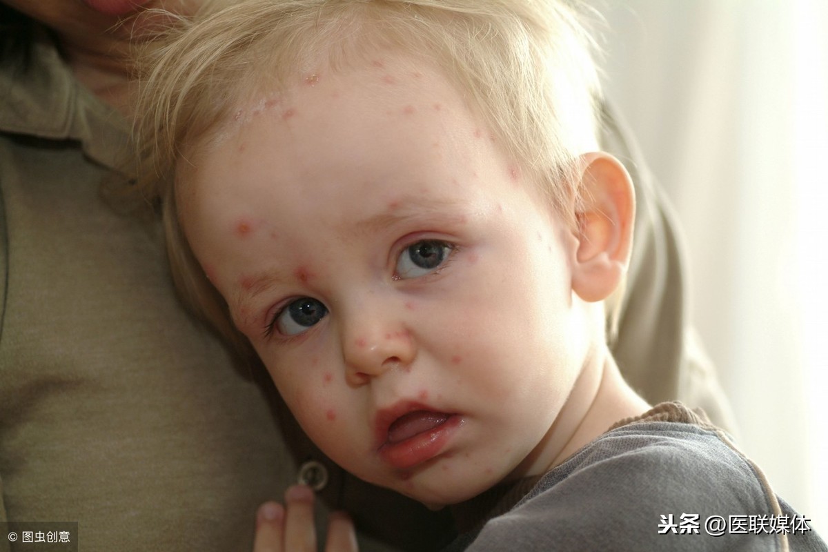 水痘图片是什么样的（春天孩子容易被传染水痘，这里有一份水痘的知识要点，家长必知） | 说明书网