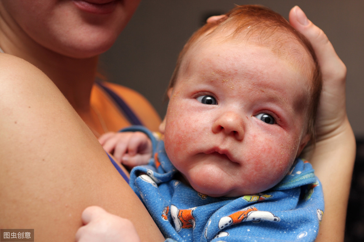 婴儿脸上长湿疹怎么护理（如何护理得了湿疹的宝宝）-幼儿百科-魔术铺