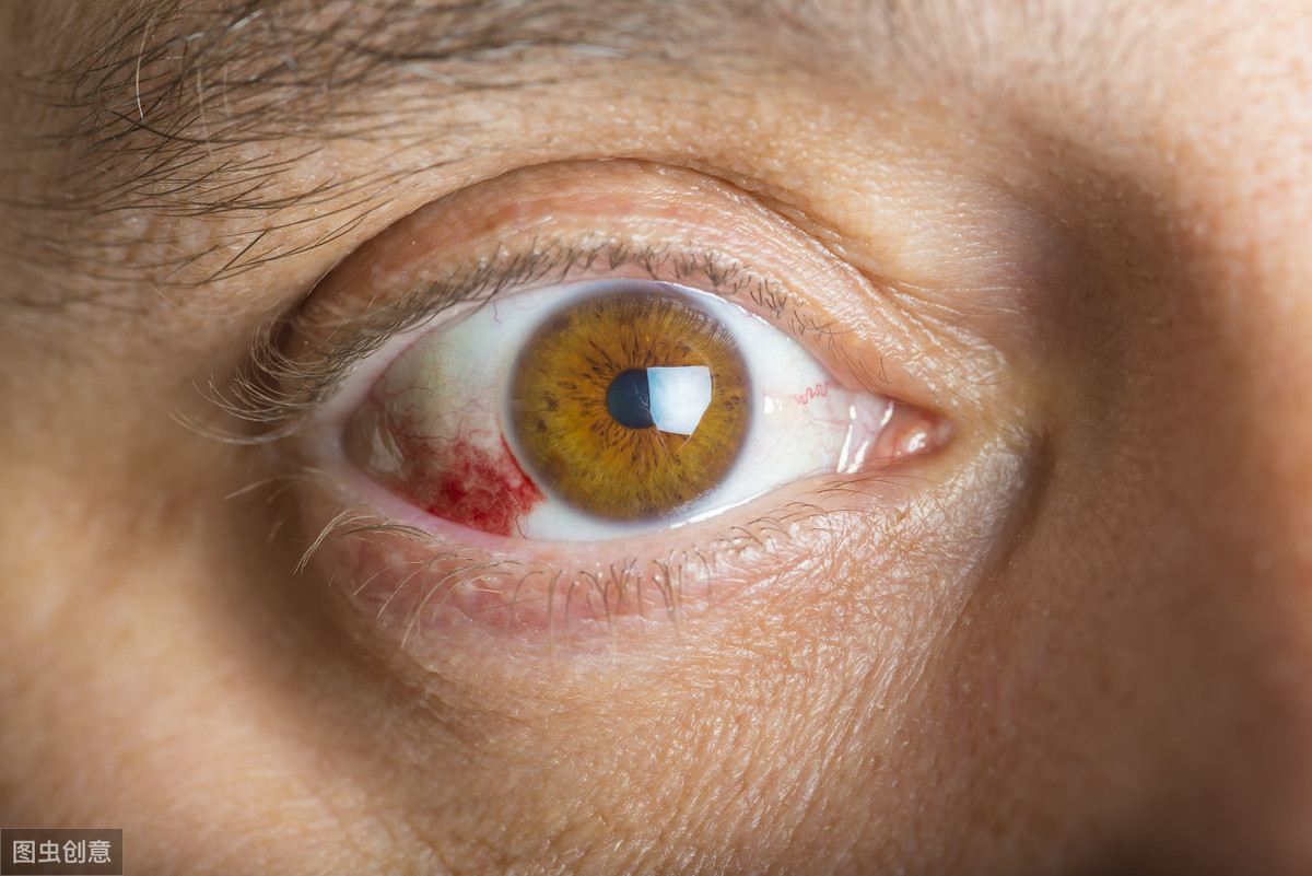 白人女性眼内断裂血管结膜下出血毛细血管破裂的临床观察. 库存照片 - 图片 包括有 经纪, 出血: 215698648