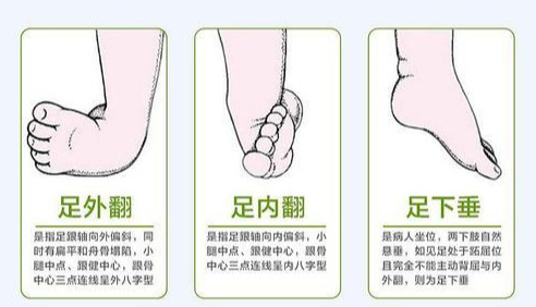 邱医生,我总觉孩子的脚与腿有问题!看看是啥呢?