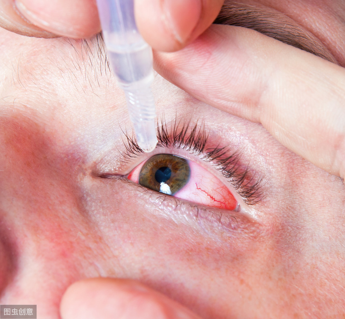 角膜炎和正常眼睛图片图片