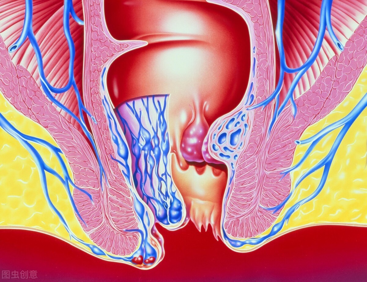 肛门长了小肉球是怎么回事？“元凶”可能是这3个，别放松警惕