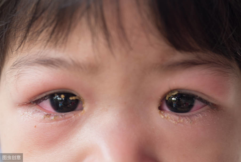 3岁女孩长针眼,亲妈当痘挤掉,感染致蜂窝组织炎 医生:太无知