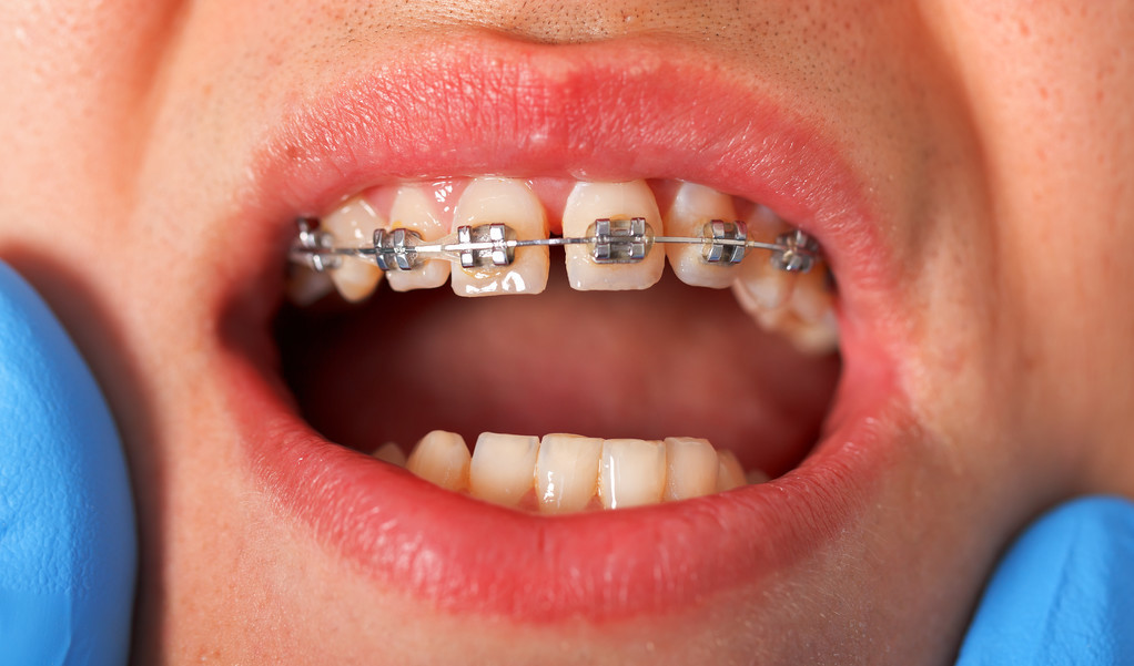 常见的习惯导致孩子兜齿，详谈兜齿形成的原因及早期的预防