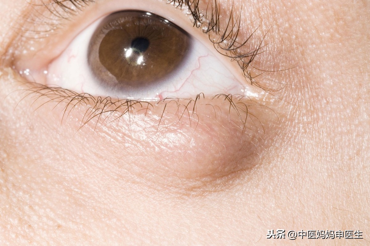 眼睛周围的脂肪粒该怎么去除？