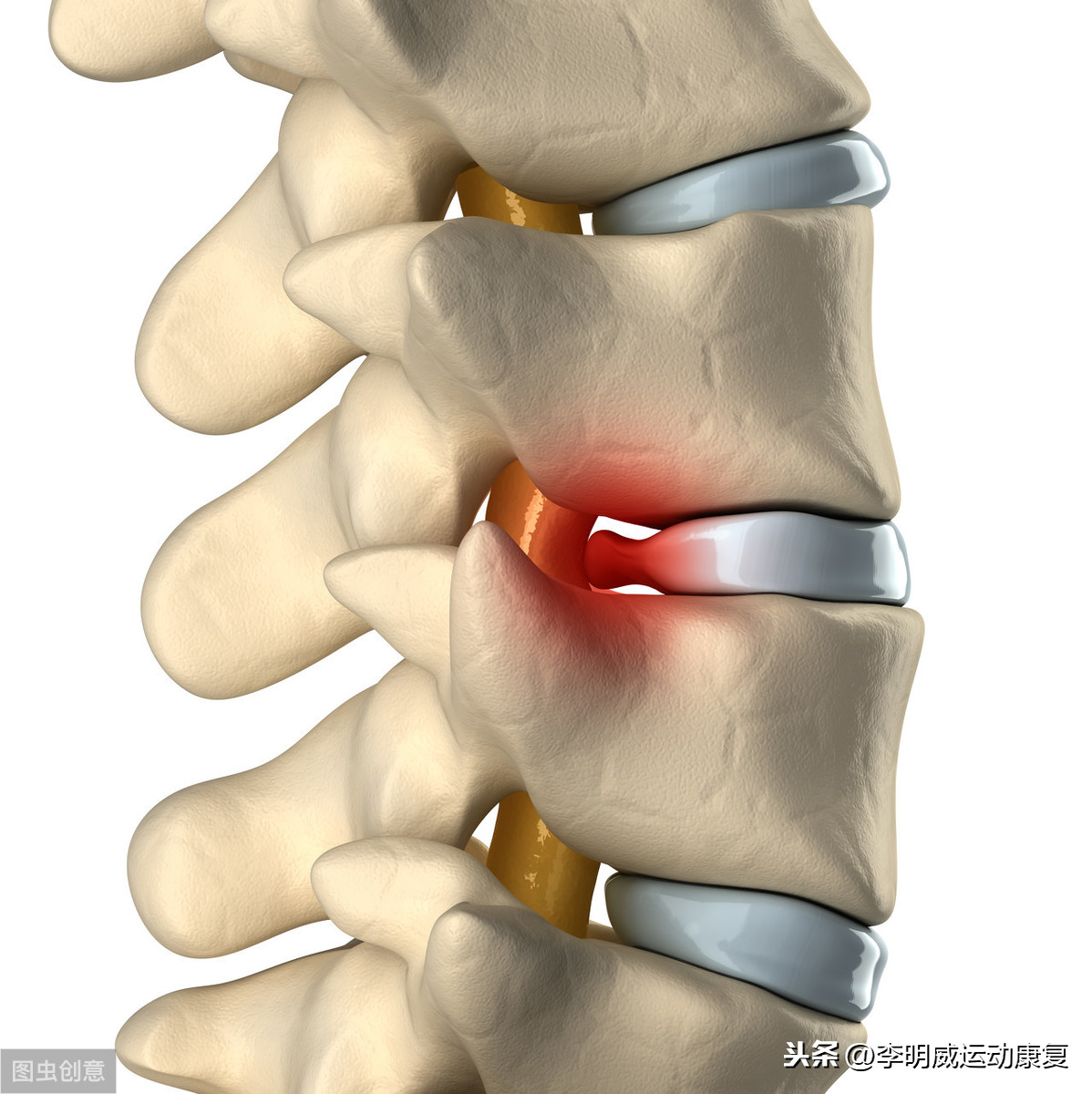 腰间盘突出能治愈吗？需要手术吗？医生不会告诉你的事实