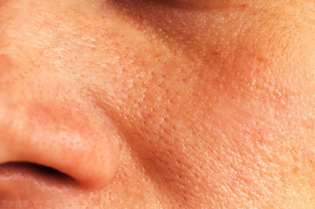为什么油性肌肤容易毛孔粗大 油性皮肤的人应该如何护理？