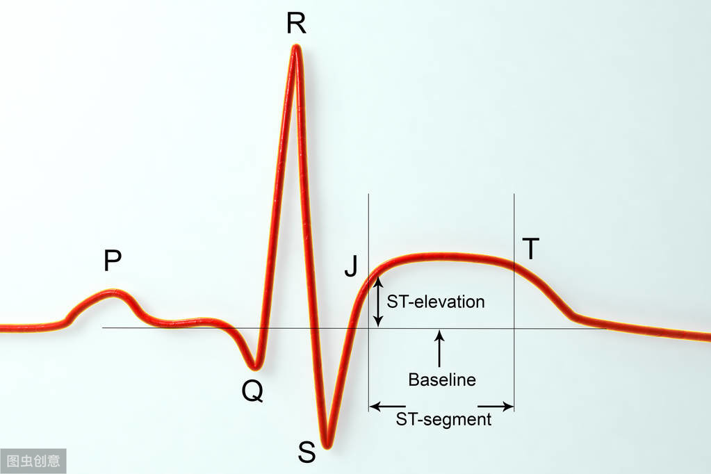 心電圖提示:st-t輕度改變是什麼病?嚴不嚴重?
