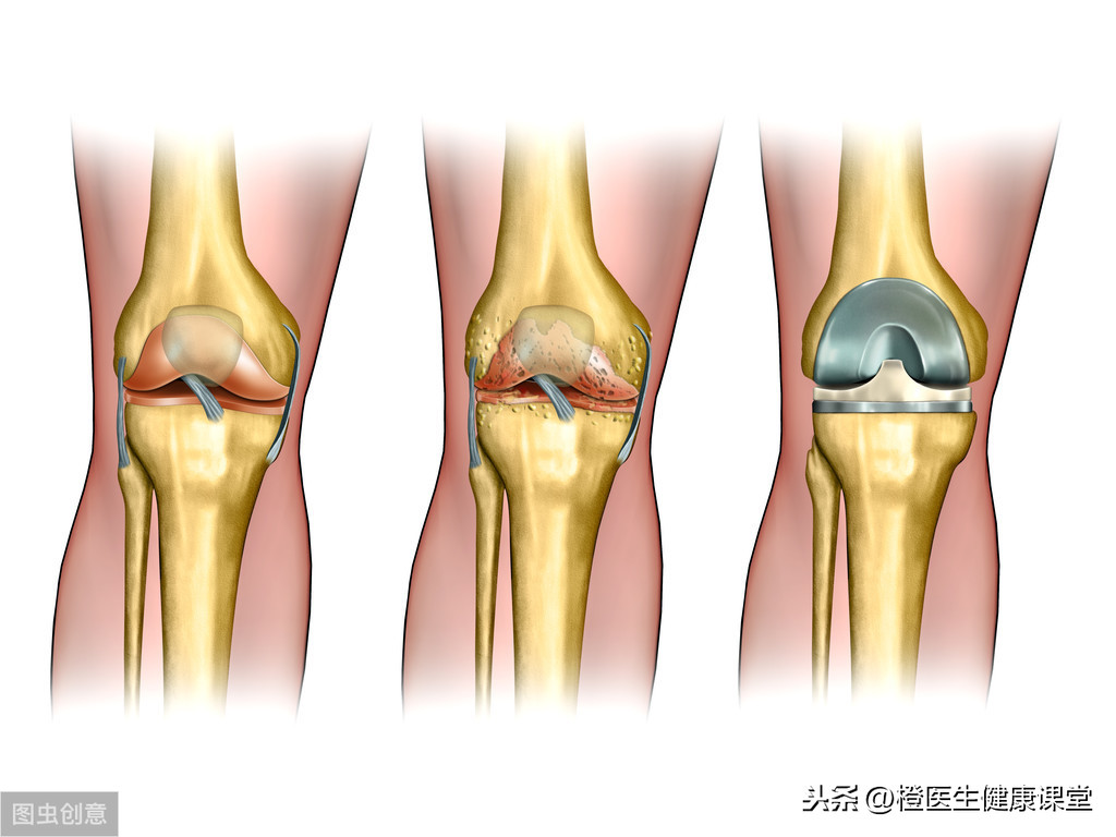 糖尿病人能吃葡萄糖胺软骨素吗？改善关节补钙，吃对时间很重要