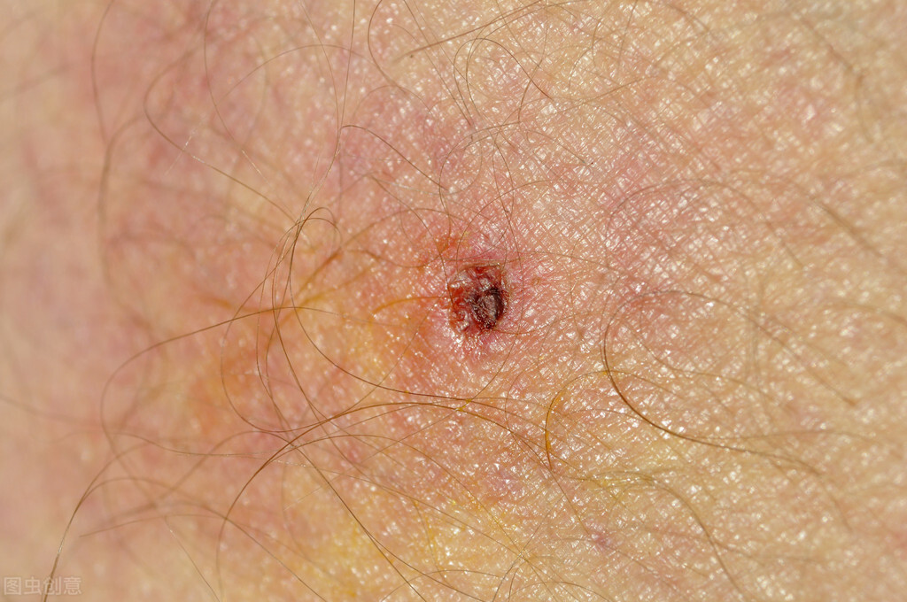 被螨虫咬的症状图片详解，螨虫性皮炎是什么？