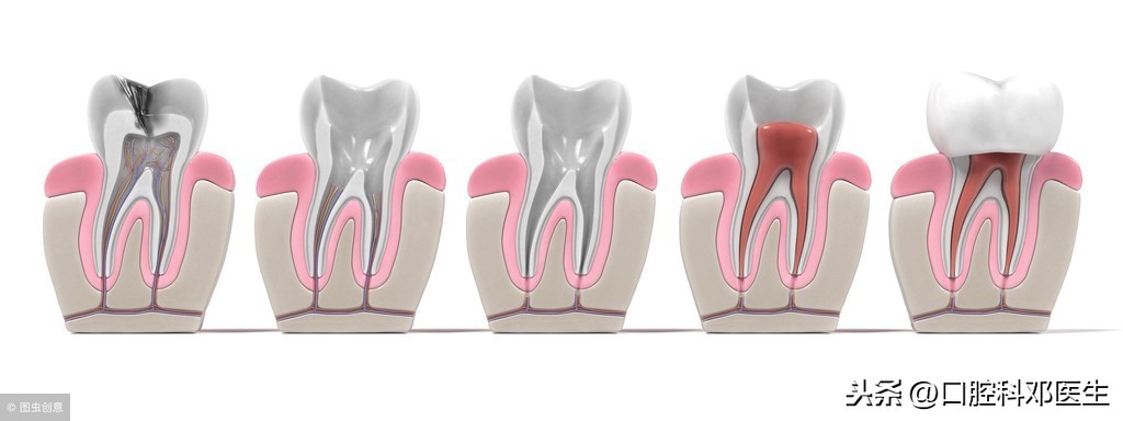 根管治疗=补牙？医生说了一万个NO，不仅仅是价钱！