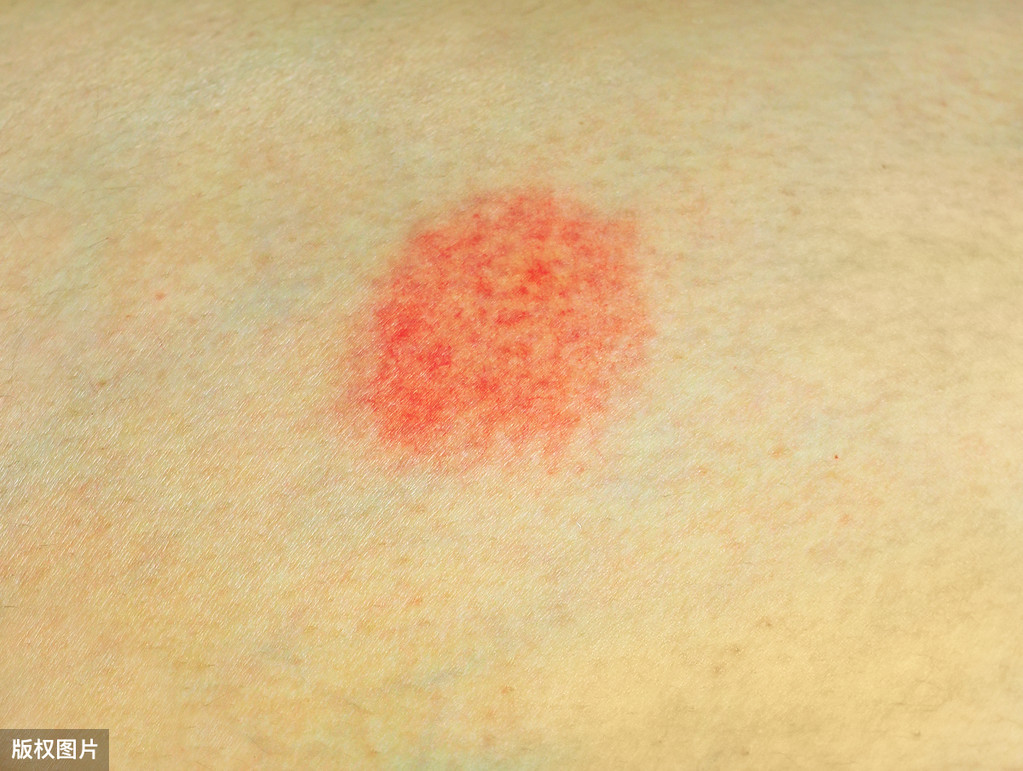 皮肤长红痣，说明肝病上身了？辟谣：很多人都弄错了
