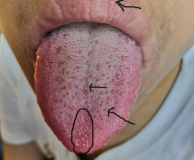 舌诊案例分析|长期熬夜,阴虚内热?舌头说明了一切