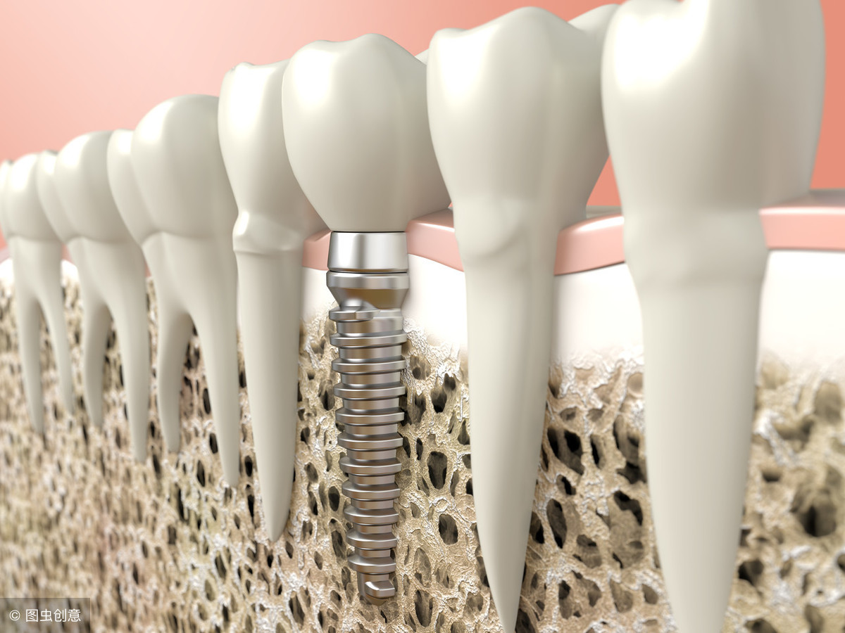 植牙一颗1万元，算贵吗？在你决定植牙前，一定要先知道这5件事