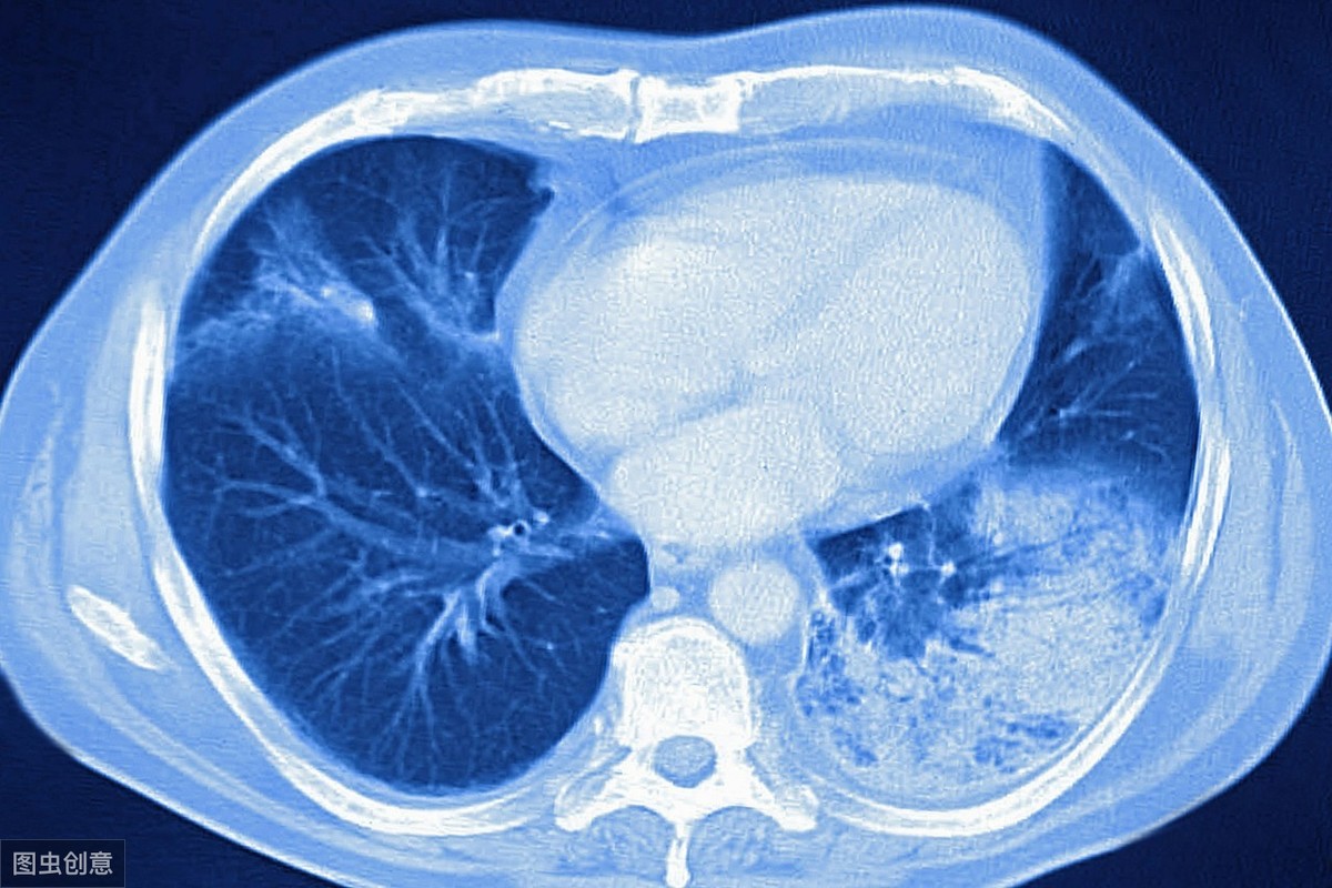 胸CT是过度医疗？多做几次会致癌？胸CT和胸片相比，有哪些利与弊