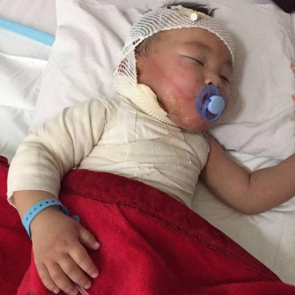 三岁孩子被100度开水烫着，妈妈用1小时4步处理，医生：做得好