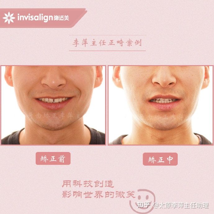 太原牙齿矫正：隐形牙套效果好不好？看这些病例你就知道了