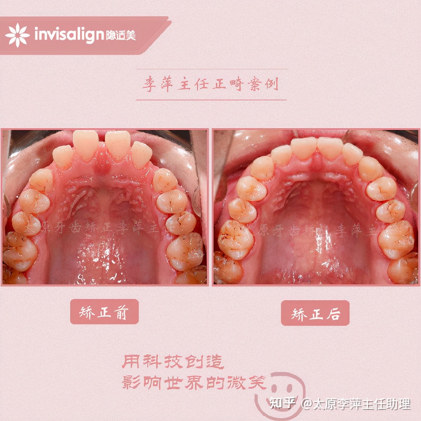 太原牙齿矫正：隐形牙套效果好不好？看这些病例你就知道了