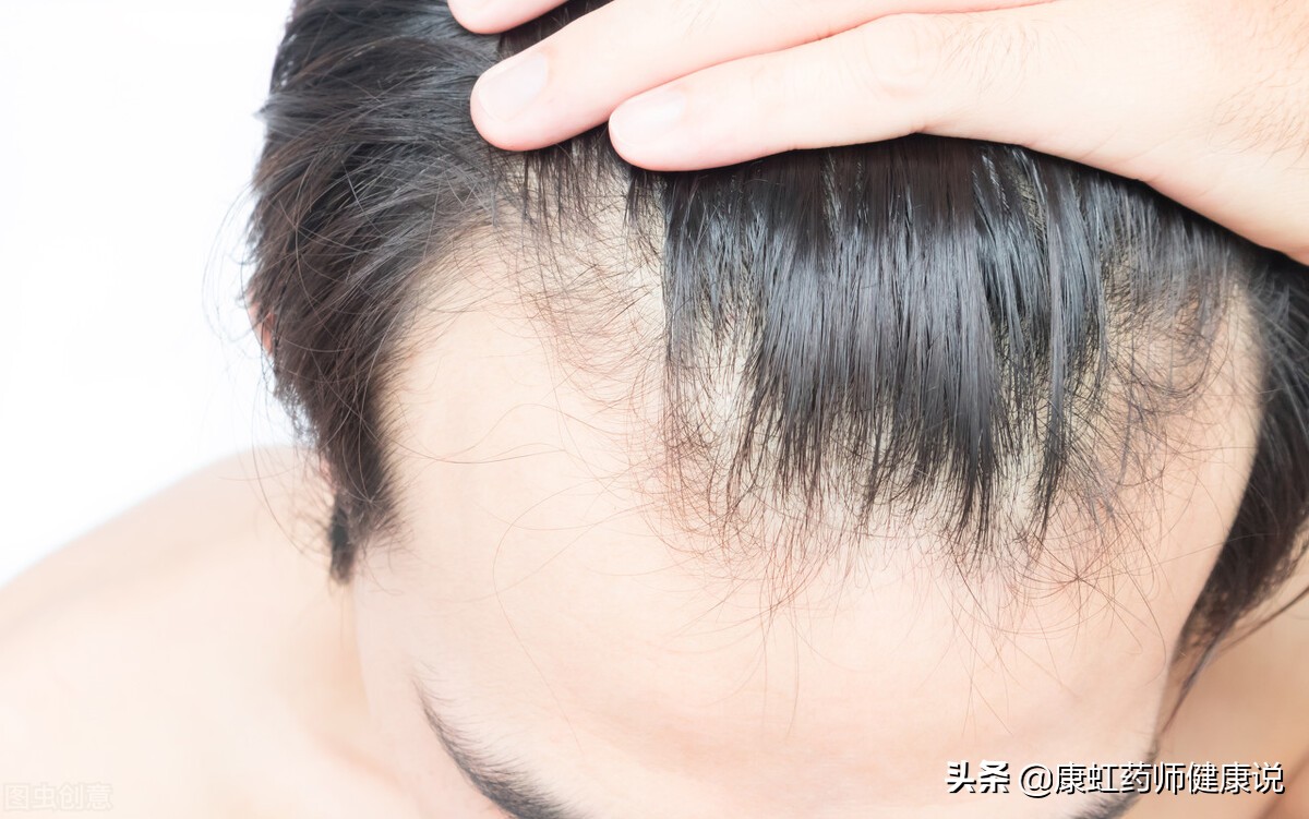 年纪轻轻，怎么就秃了？脱发究竟能不能治好？一文为你讲清楚