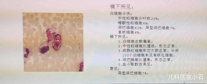 EB病毒感染是什么？严重吗？