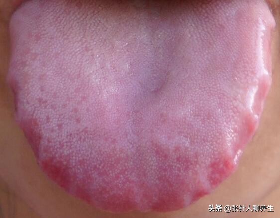 荣舌舌象特征: 舌质荣润红活,有生气,有光彩,舌体活动自如,故谓舌之有