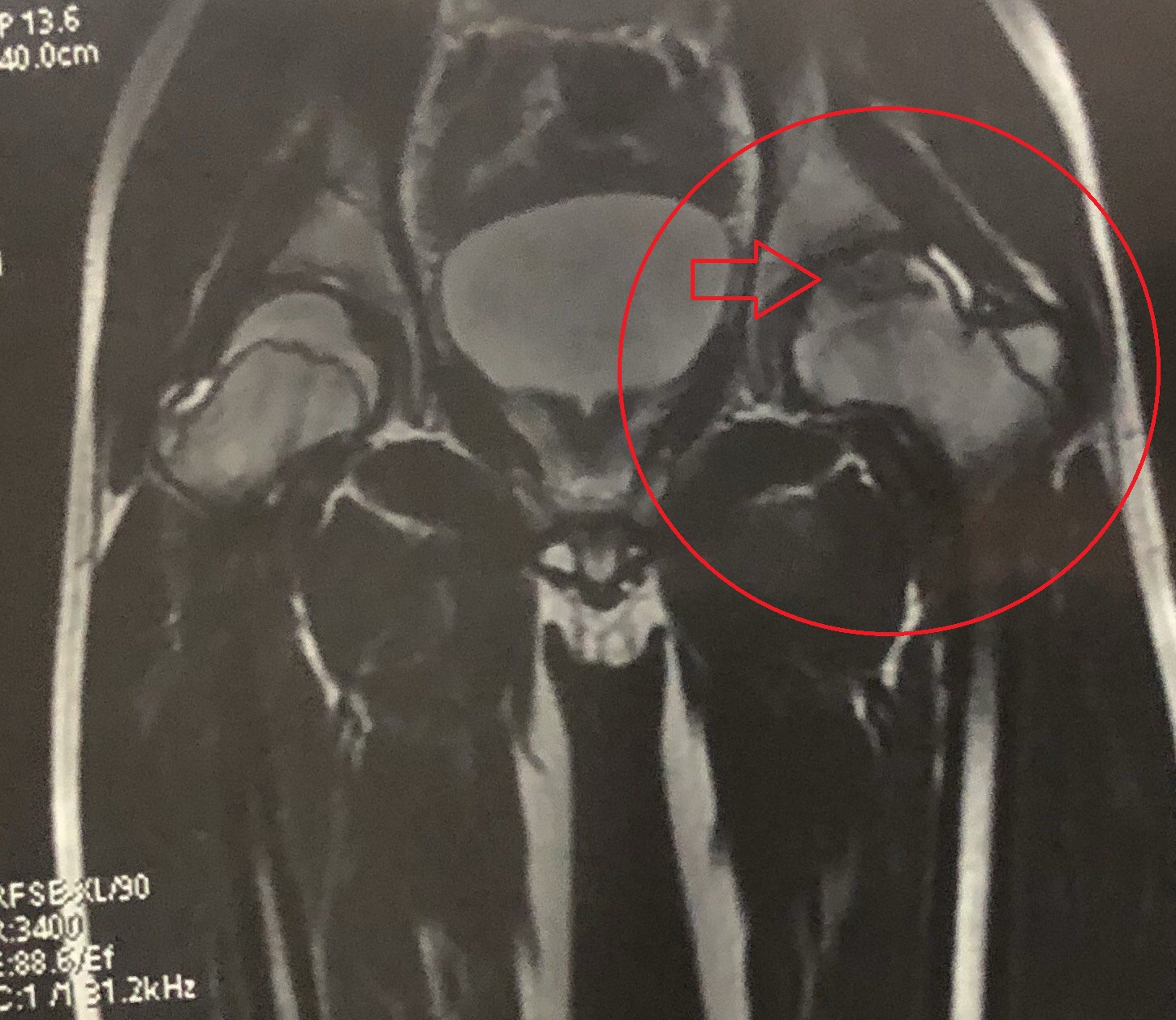 髋关节积液磁共振图片