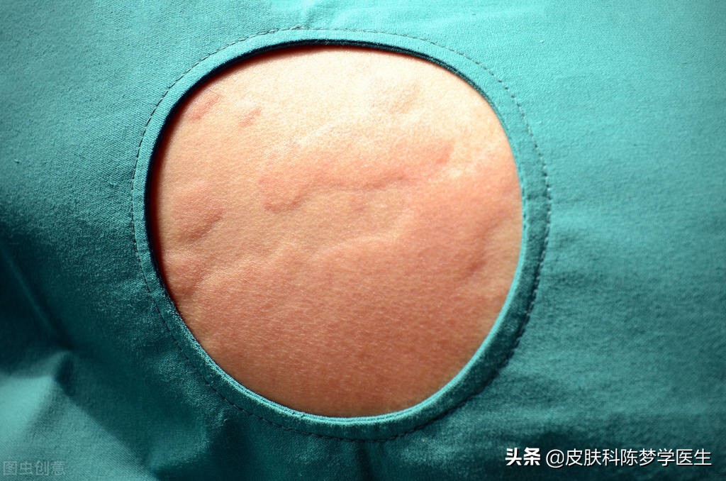 妙用中医经方,赶走反复难缠的荨麻疹