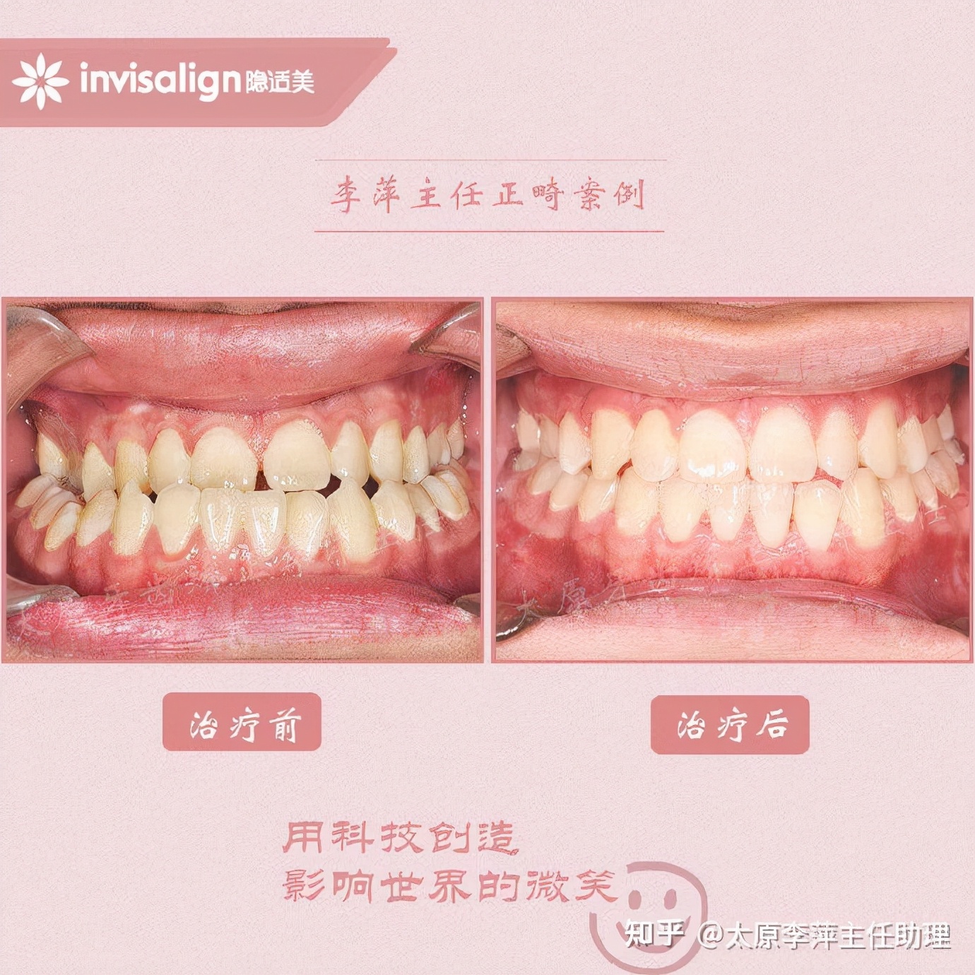 太原牙齿矫正：隐形牙套效果好不好？看这些病例你就知道了