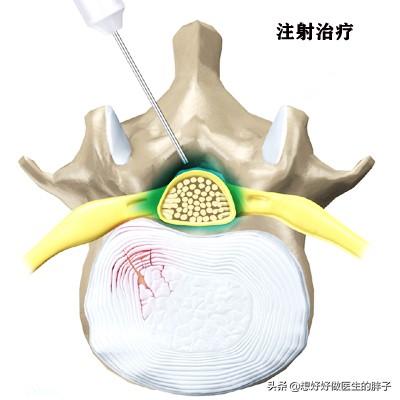 腰椎间盘突出压迫神经可以尝试保守治疗，但是需要医患配合和耐心